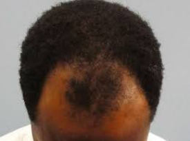 Mozambique starts killing of bald men